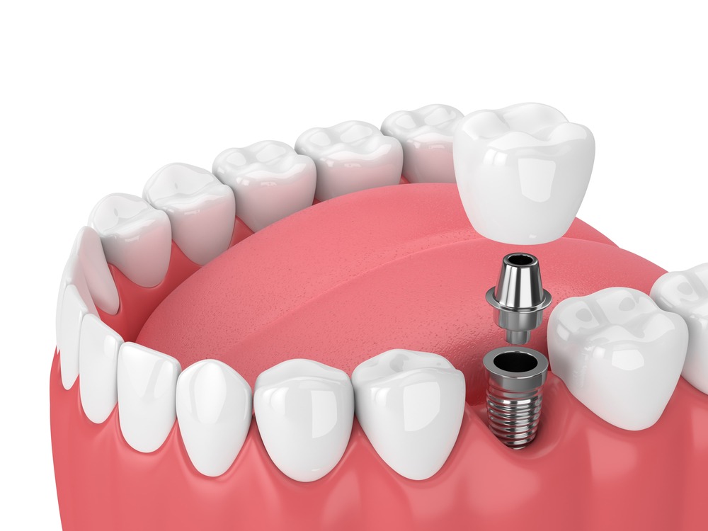 Riverton Dental Implants | South Jordan Dental Implants - Riverton Dental